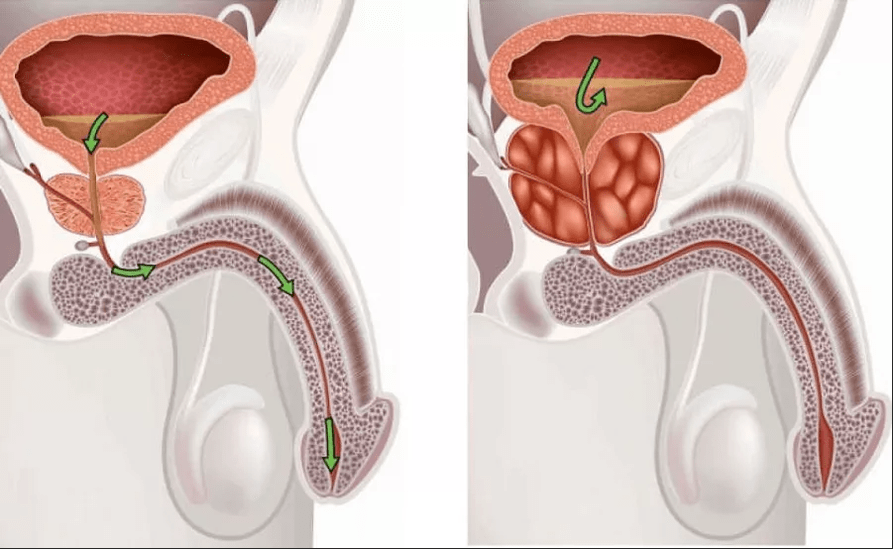 Sintomas de prostatite